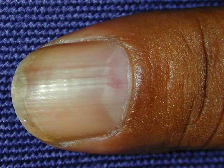 Glomustumor | HandsOnCare Klinieken